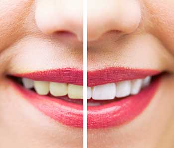 The image is a composite of two photos placed side by side, showing the transformation of a person's teeth from yellow to white.