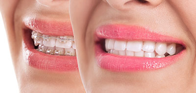 The image shows a close-up of a woman's face with a focus on her teeth, which are covered in pink lipstick.