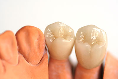 The image shows a set of artificial teeth with varying shades and textures, presumably for dental implants or prosthetics.