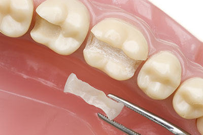 Dental implant with a surgical guide in place, set against a pink dental mold.