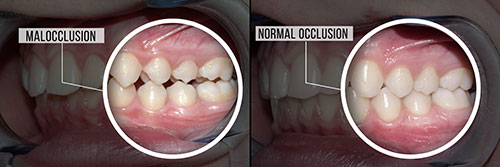 The image shows a before-and-after comparison of a dental implant procedure, with the left side showing an oral cavity with missing teeth and the right side displaying the same area after receiving dental implants.