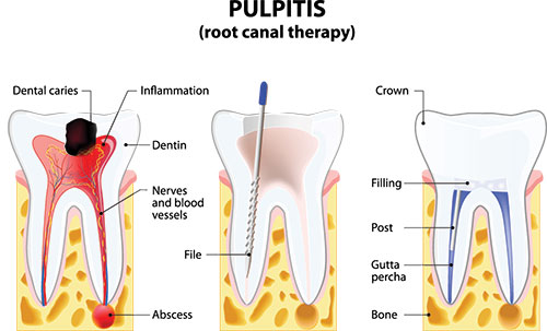 The image is a medical illustration showing a cross-section of a tooth with pulpitis, labeled with annotations such as 'root canal therapy,' 'dental caries,' and 'inflammation.' It also includes a diagrammatic representation of a tooth with the pulp and surrounding structures highlighted.
