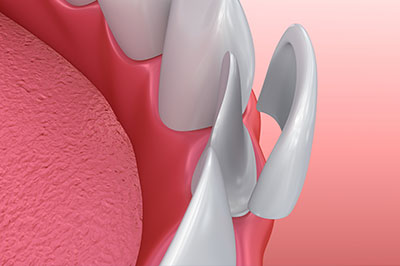 The image displays a close-up of a dental implant with a screw and abutment, set against a pink background that resembles gum tissue.