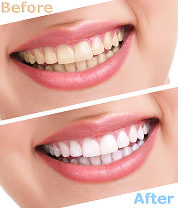 The image shows a woman with a smile, before and after images of teeth whitening, highlighting the improvement in her teeth's brightness.