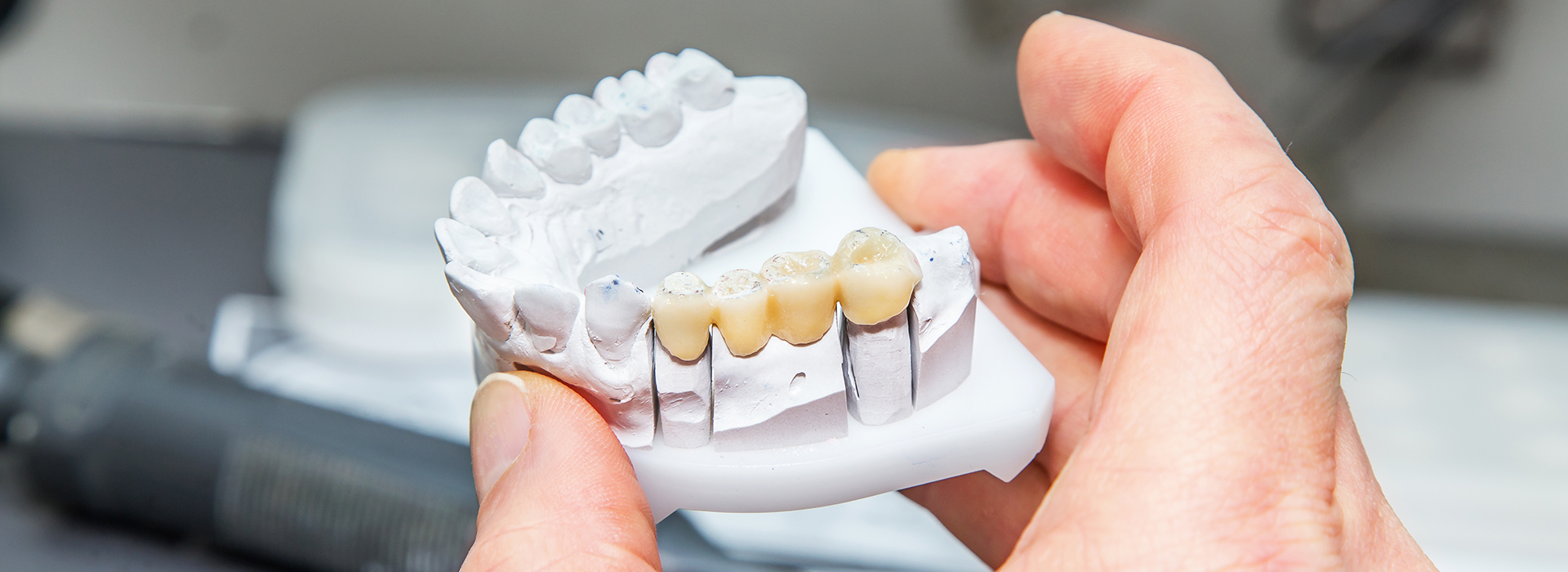 A person holding a 3D printed dental model.