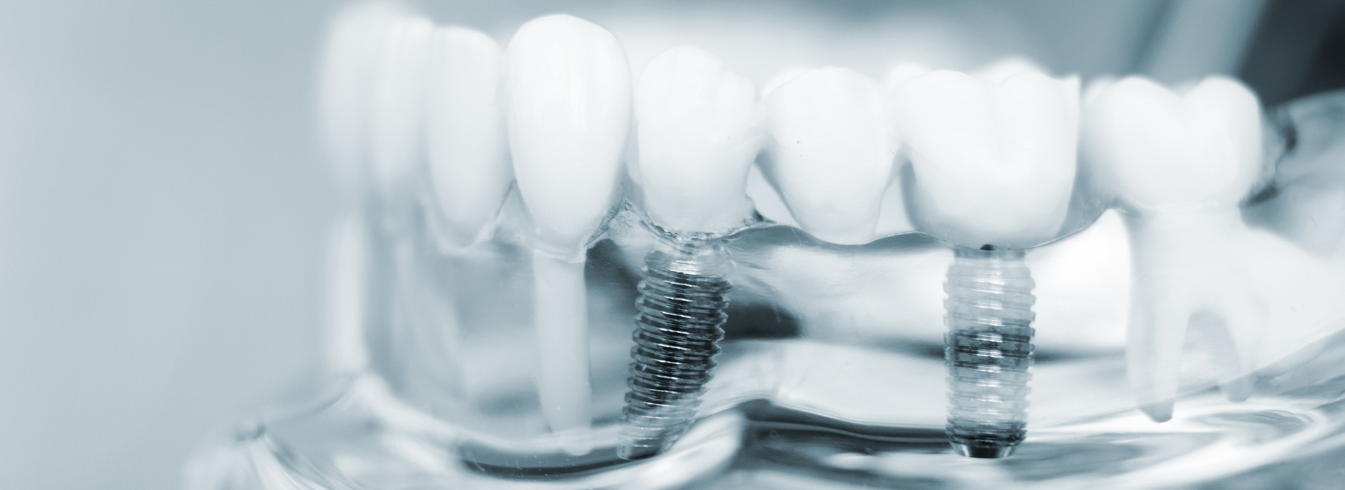 The image shows a close-up of a dental implant with screws, set against a blurred background that appears to be a mouthpiece or dental appliance.