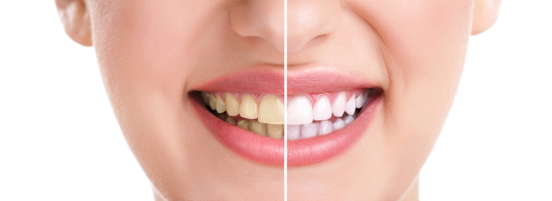 A before-and-after comparison of a person's teeth, highlighting the transformation from yellow to white.