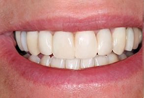 The image is a close-up photograph of a person's smiling face, showcasing their teeth and mouth.
