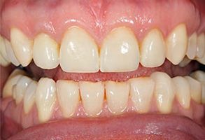 The image displays a close-up of a person's teeth, showing a bright yellowish hue and some wear on the enamel.