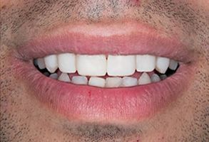 The image features a close-up of a person's smile, showcasing teeth and lips, with the individual appearing to be male.