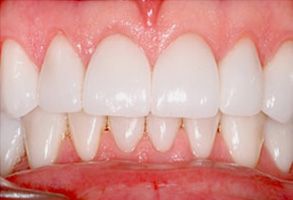 The image shows a close-up of a person's teeth with an emphasis on the lower front teeth, which appear to be in need of dental care.