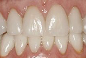 The image shows a close-up of a person's teeth, with the focus on the lower front teeth, which appear to be discolored or stained.