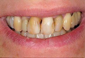 The image is a close-up photograph of an individual's mouth, showcasing yellowed teeth with some staining and discoloration.