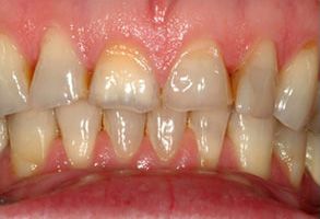 The image shows a close-up of a person's teeth with a focus on the lower front teeth, which appear to be discolored and in need of dental care.